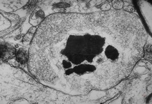 F,15y. | infantile neuroaxonal dystrophy (Seitelberger)